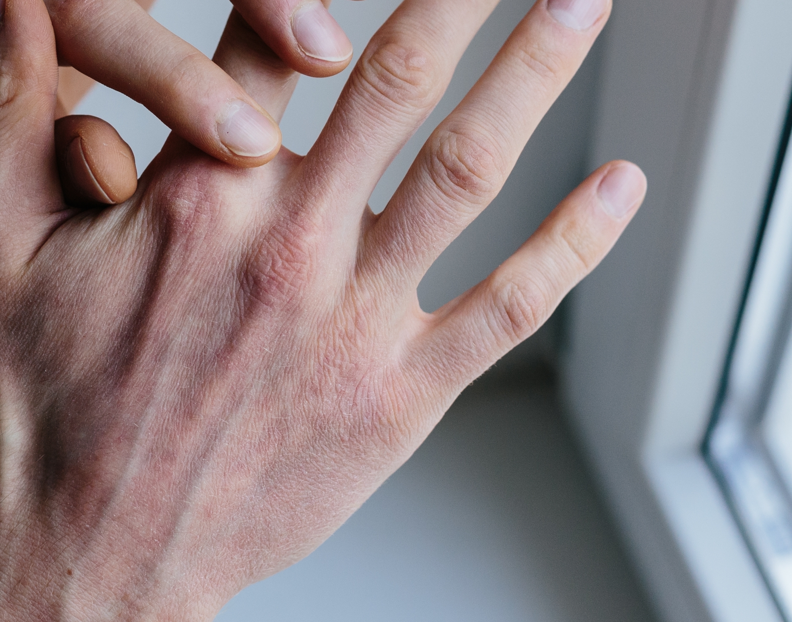 Comment attrape-t-on du psoriasis ?