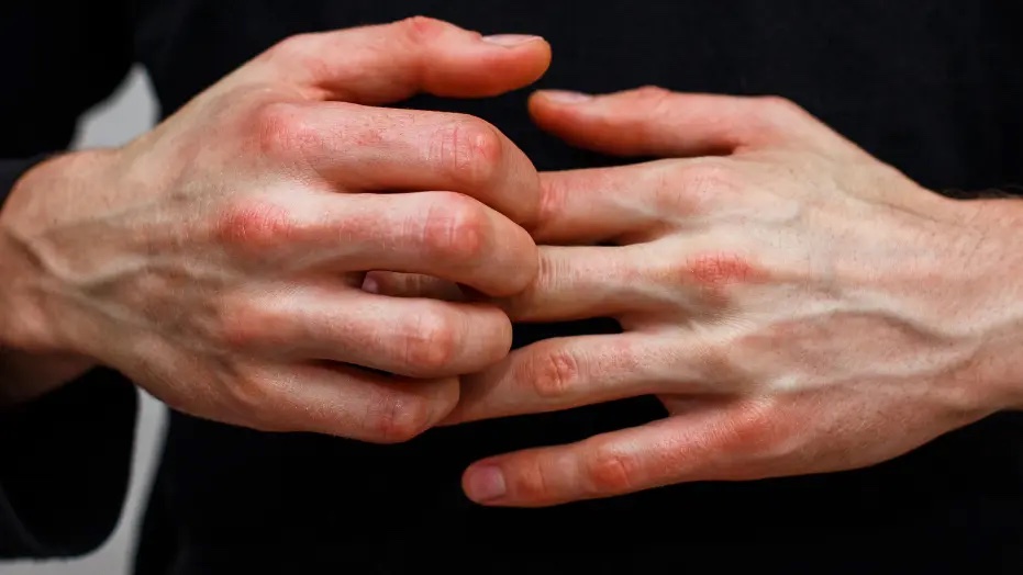 Souffrir du psoriasis ne doit plus être une fatalité