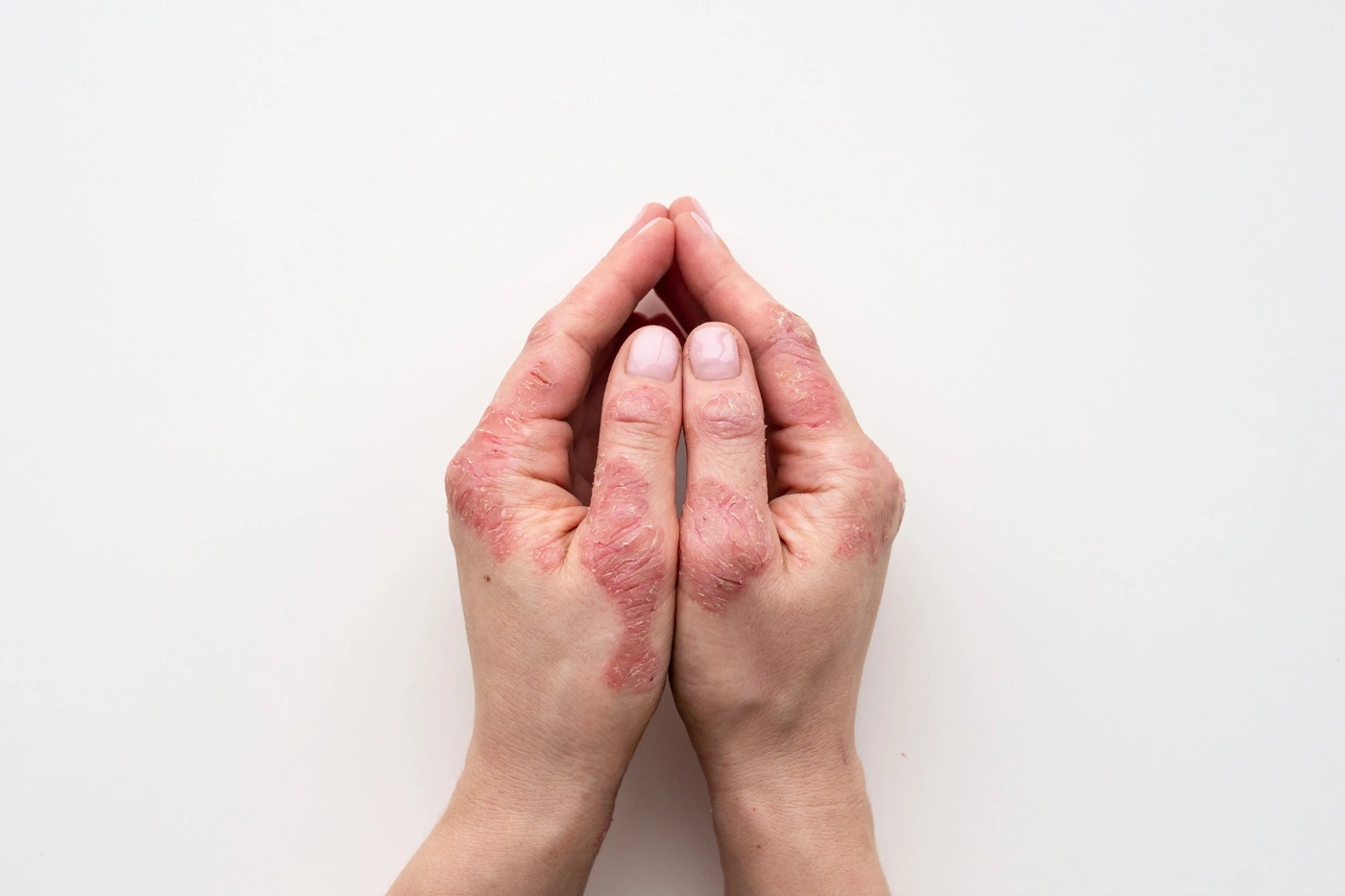 Ces zones du corps que le psoriasis n’épargne pas